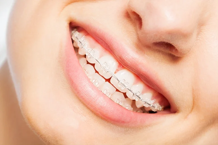 How Do Modern Clear Braces Improve Smiles and Confidence for Patients in Las Vegas