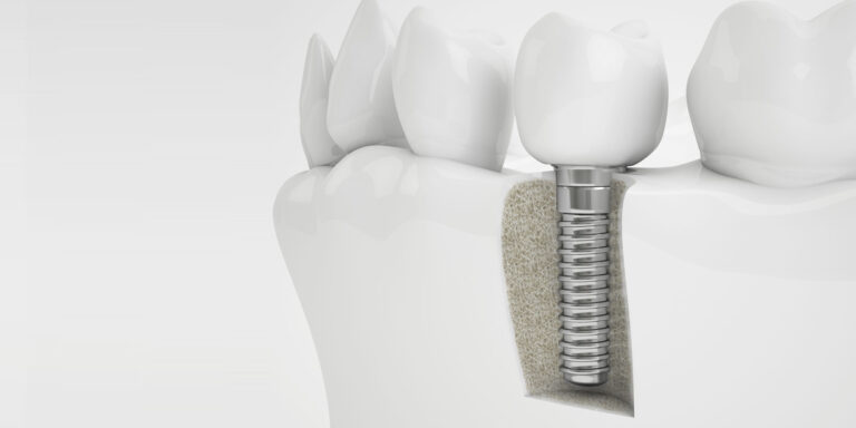 All You Need to Know About Same Day Teeth Replacement in Falls Church